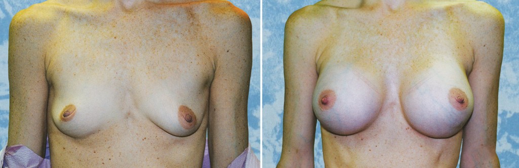 Breast Augmentation