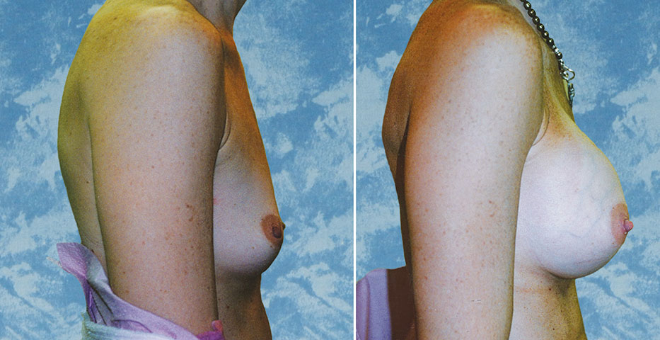 Breast Augmentation