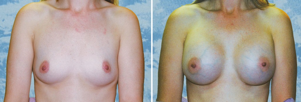 Breast Augmentation