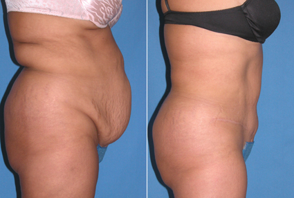 Abdominoplasty Tummy Tuck