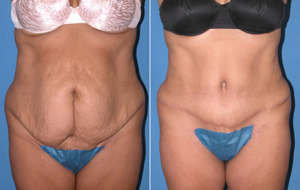 Abdominoplasty Tummy Tuck