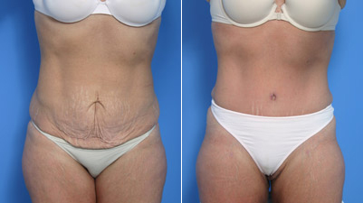 Abdominoplasty Tummy Tuck