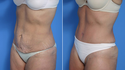 Abdominoplasty Tummy Tuck