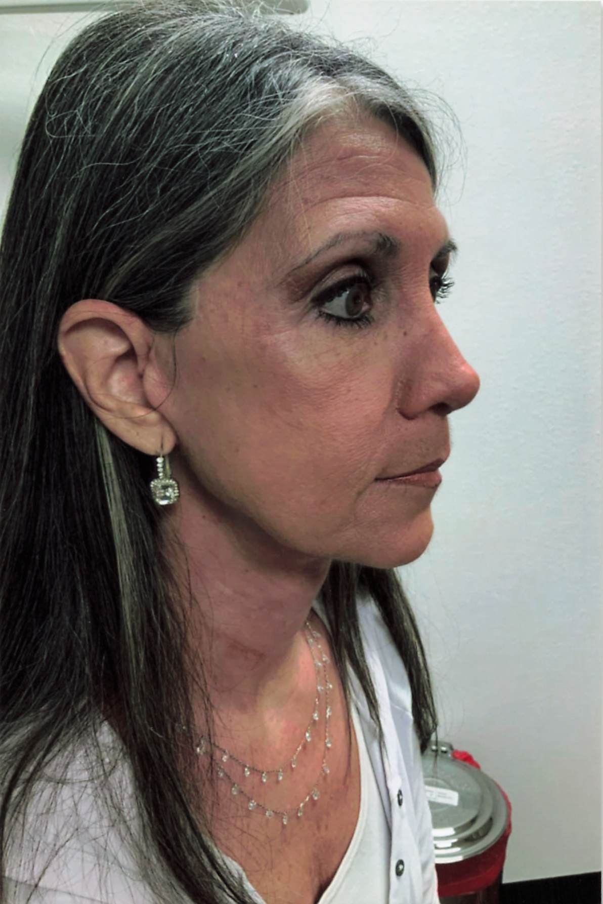 After Facelift