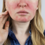 Photo facial