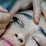 Blepharoplasty