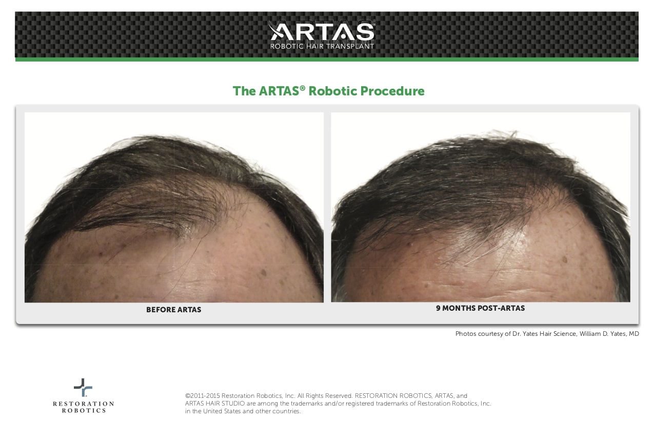 ARTAS Before After Dr. William D. Yates 2.