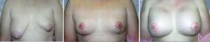 Complicated breast lift reduction