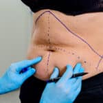 Liposuction