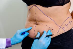 Liposuction