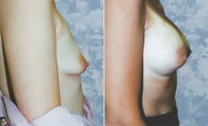 breast augmentation 14