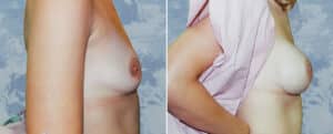 breast augmentation 2