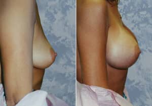 breast augmentation 20