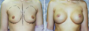 breast augmentation 3