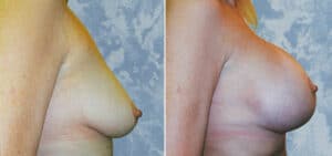breast augmentation 89