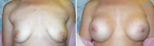 breast lift 3