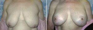 breast lift reduction 10