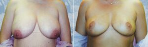 breast lift reduction 2