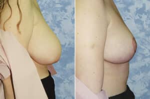 breast lift reduction 3