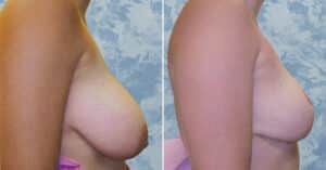 breast lift reduction 5