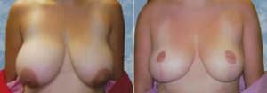 breast lift reduction 6