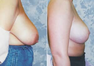 breast lift reduction 9