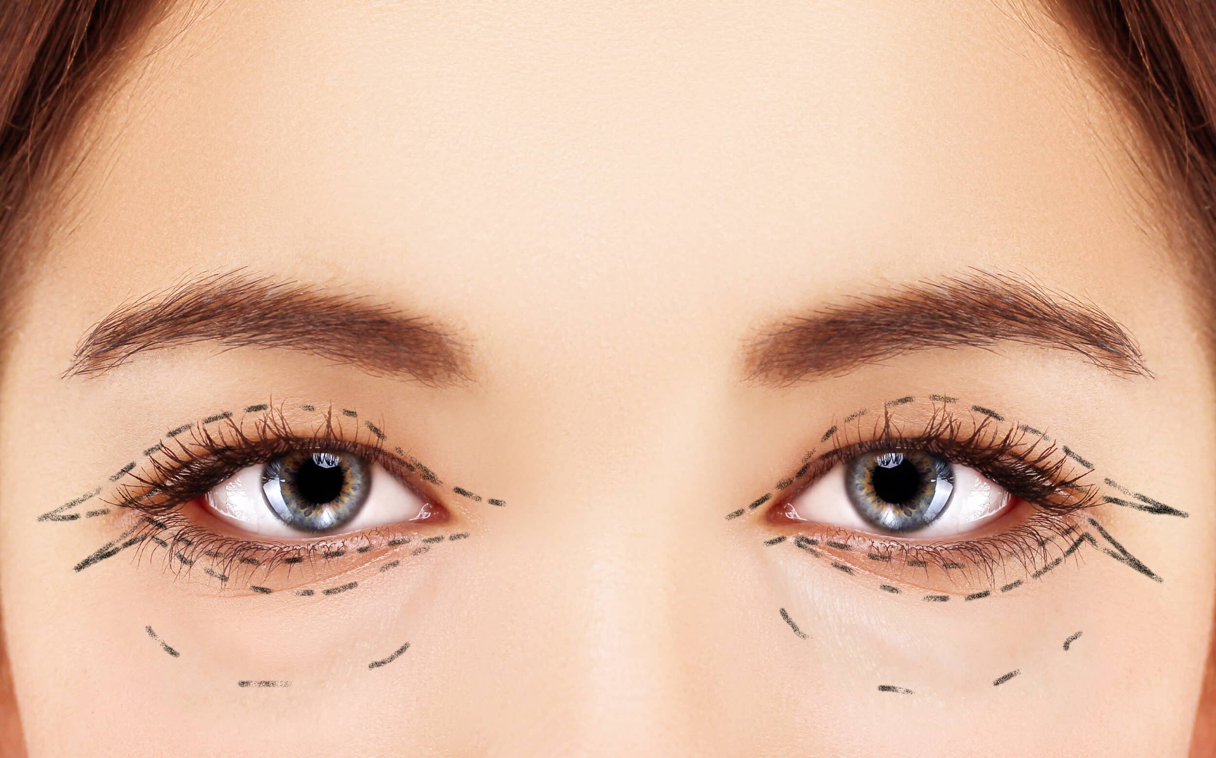 Lower Blepharoplasty.Upper blepharoplasty.Marking the face.Perforation lines on females face, plastic surgery concept.