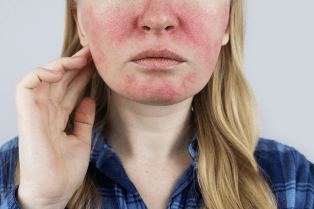 rosacea IPL treatments