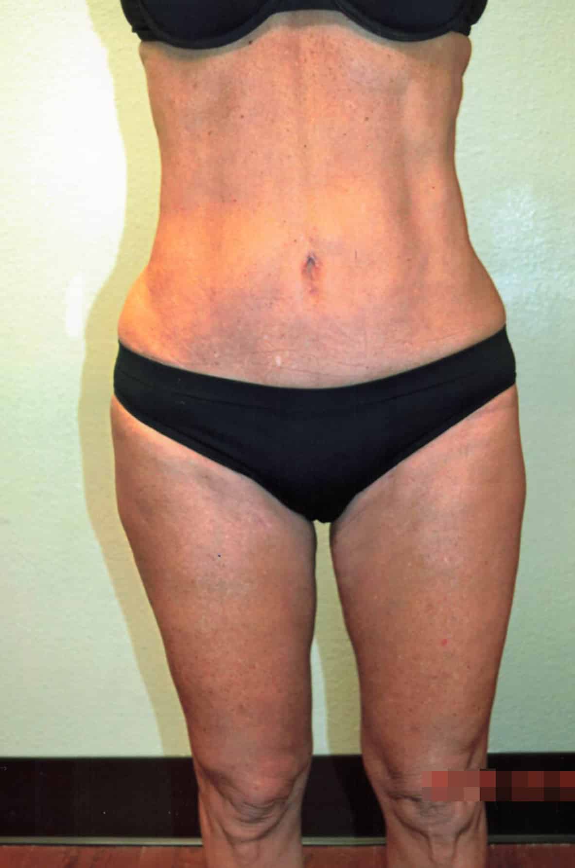 After Image: Tummy Tuck with Liposuction - front