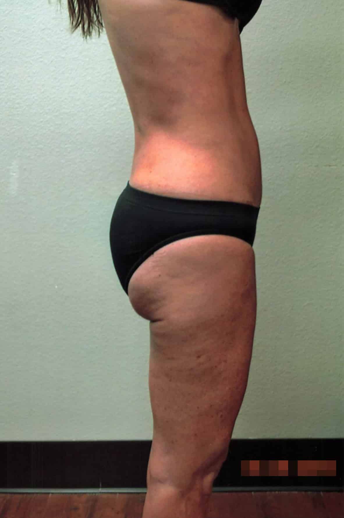 After Image: Tummy Tuck with Liposuction - right-side