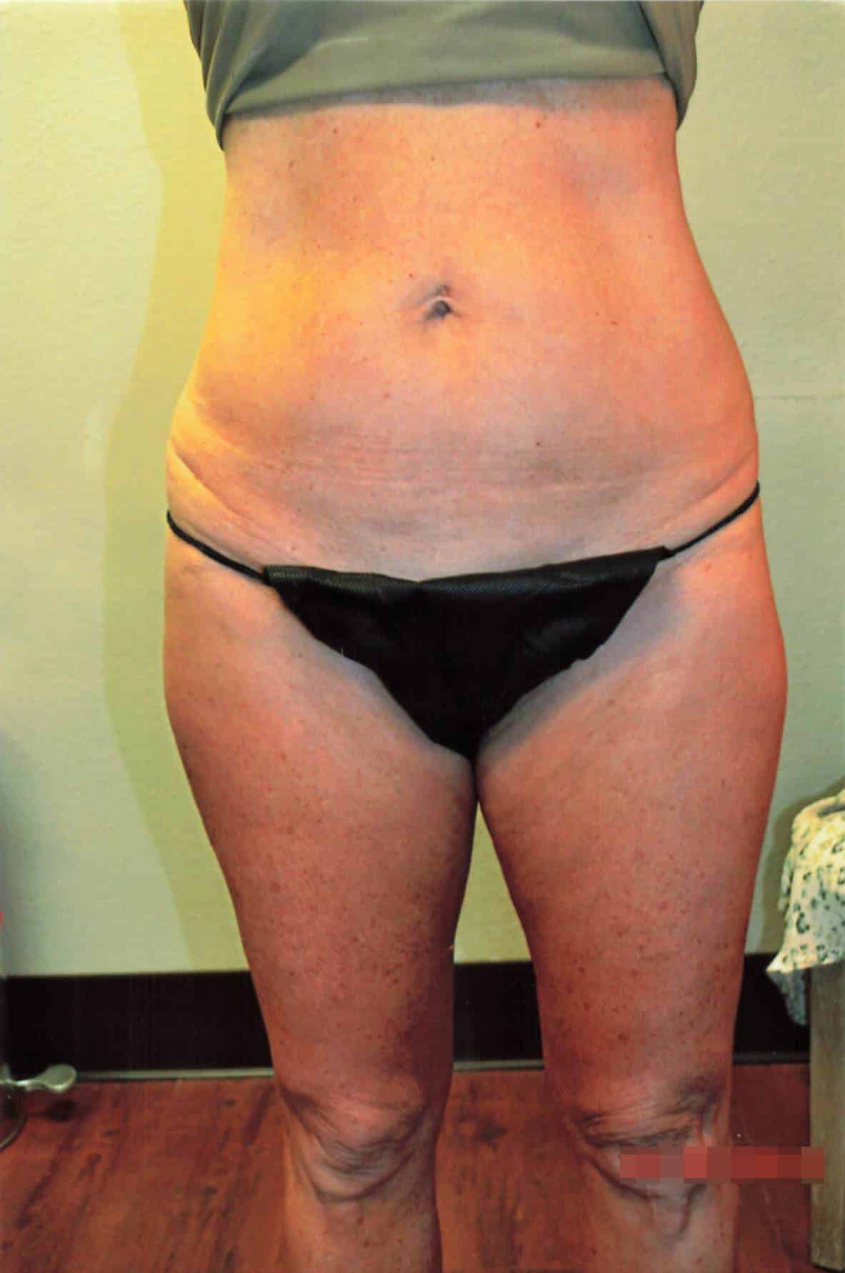 Before Image: Tummy Tuck with Liposuction - front