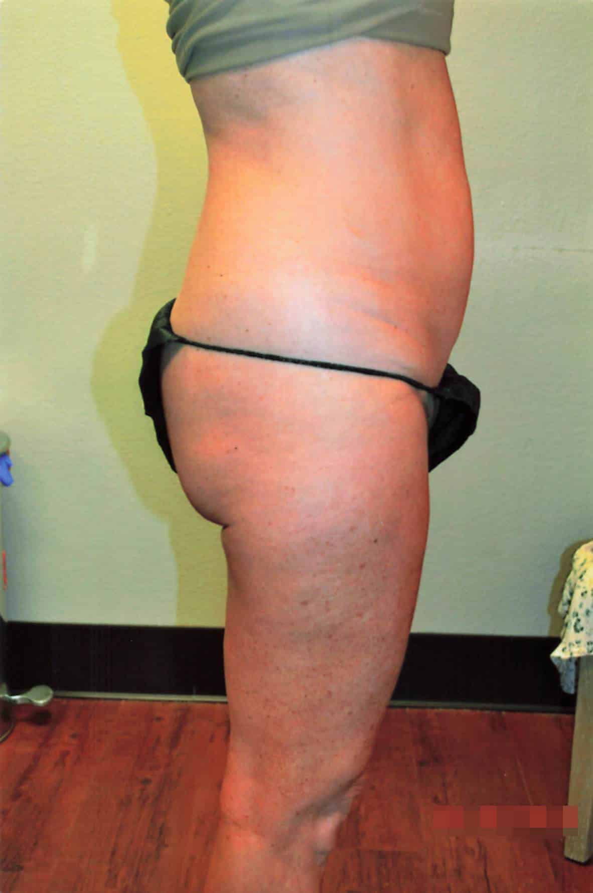 Before Image: Tummy Tuck with Liposuction - right-side