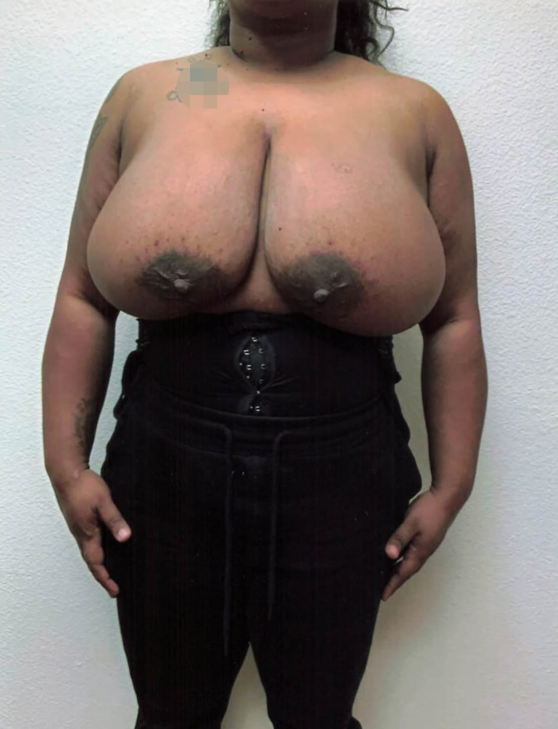 Before Image: Breast Reduction - front