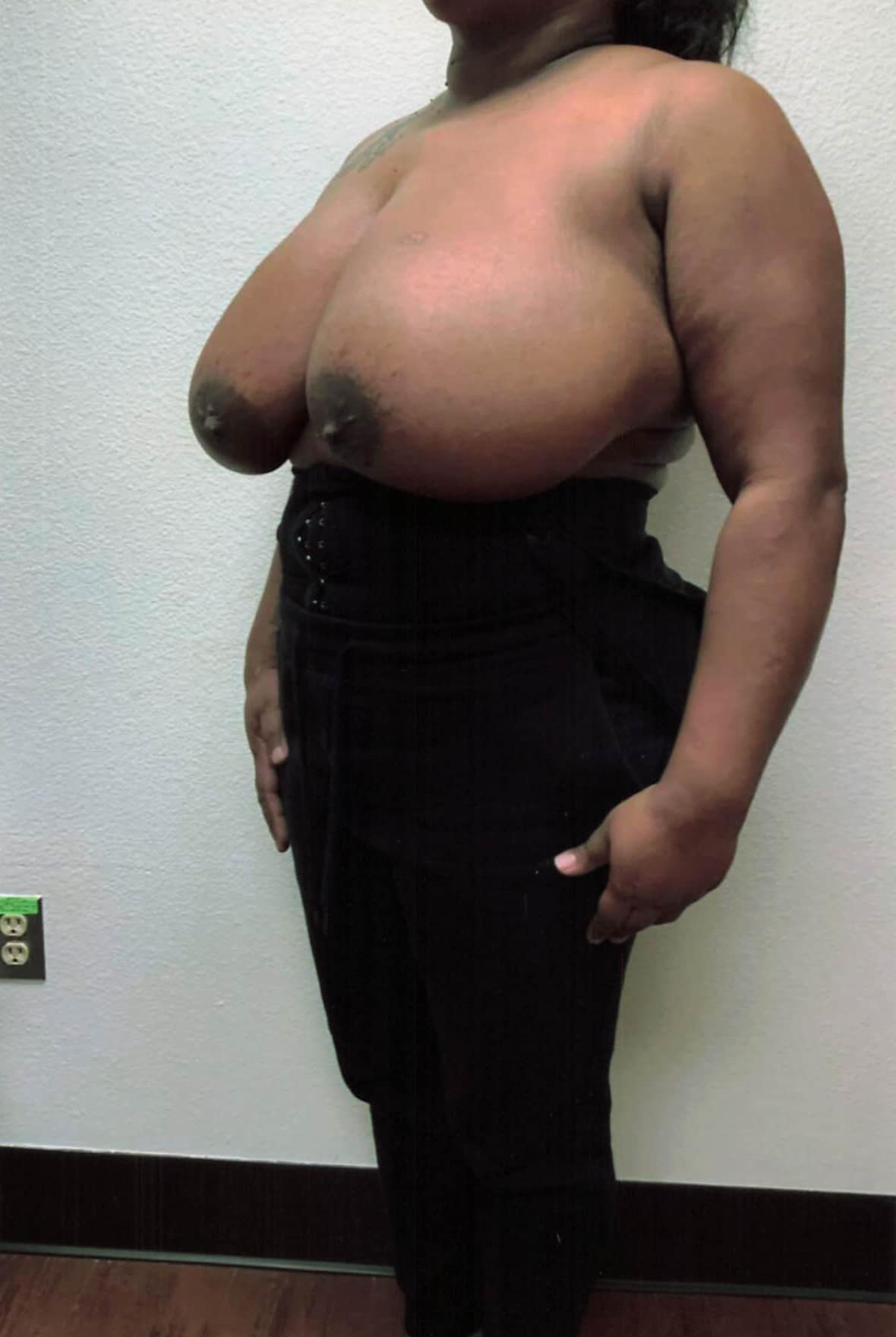 Before Image: Breast Reduction - left-front-oblique