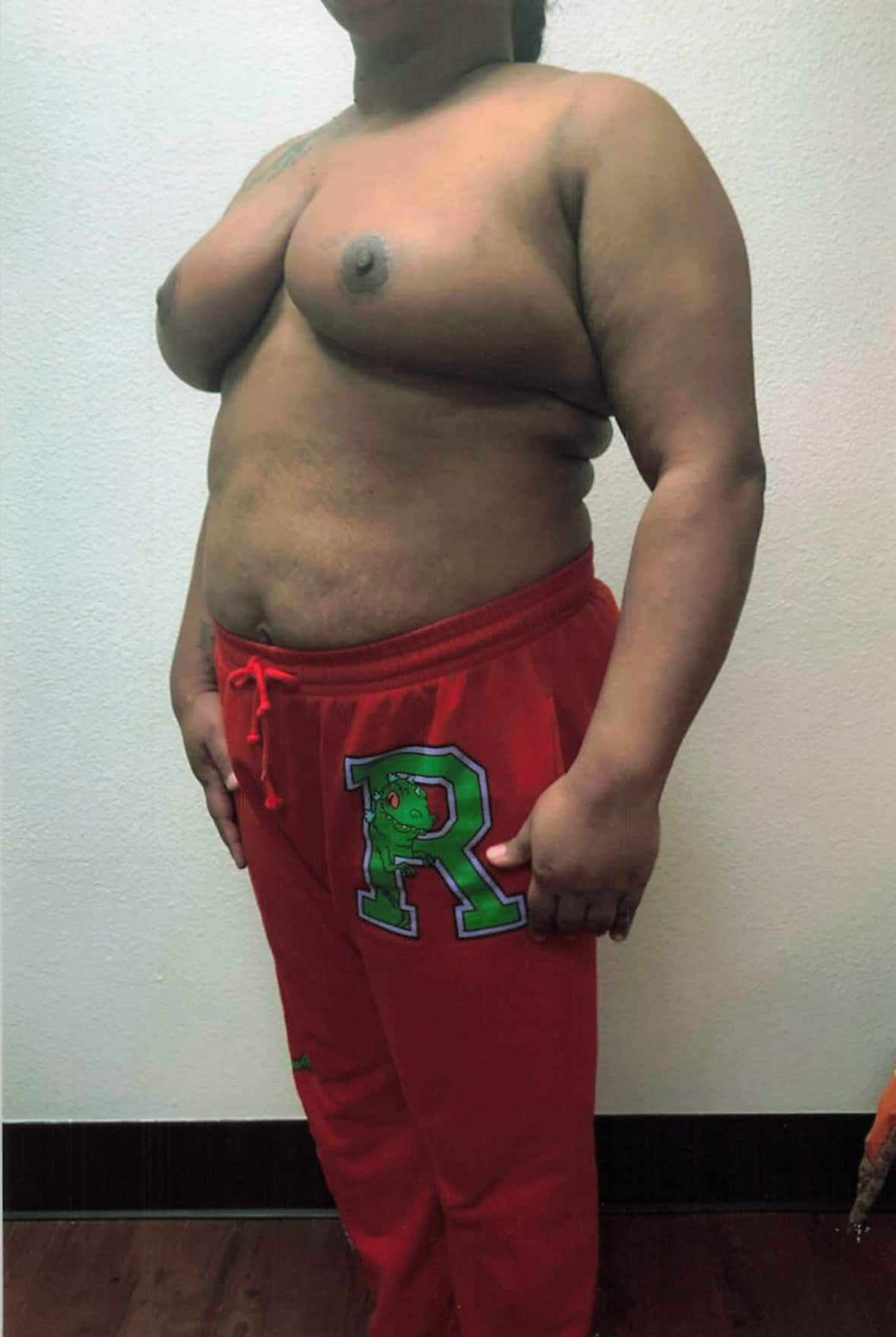 After Image: Breast Reduction - left-front-oblique