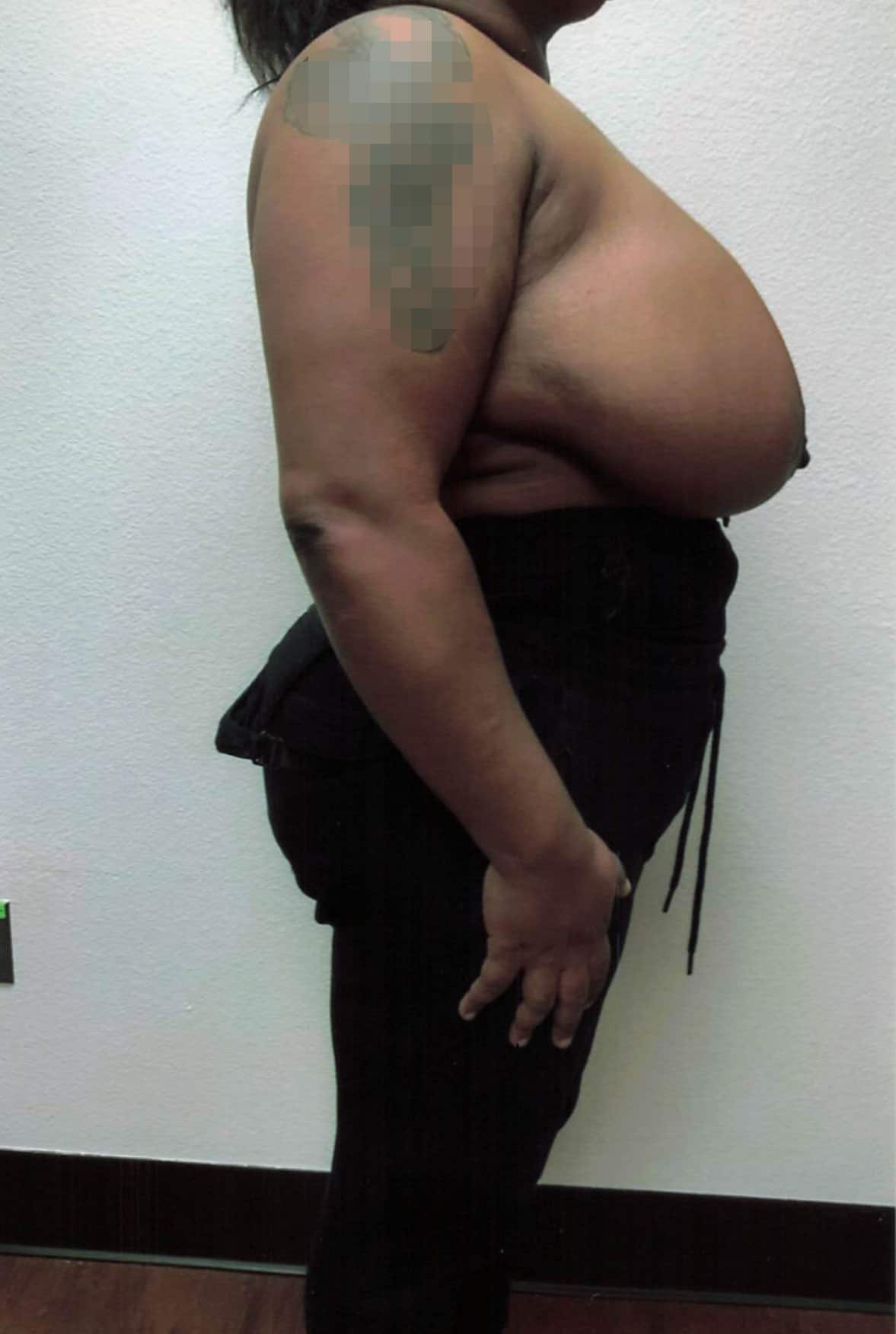 Before Image: Breast Reduction - right-side