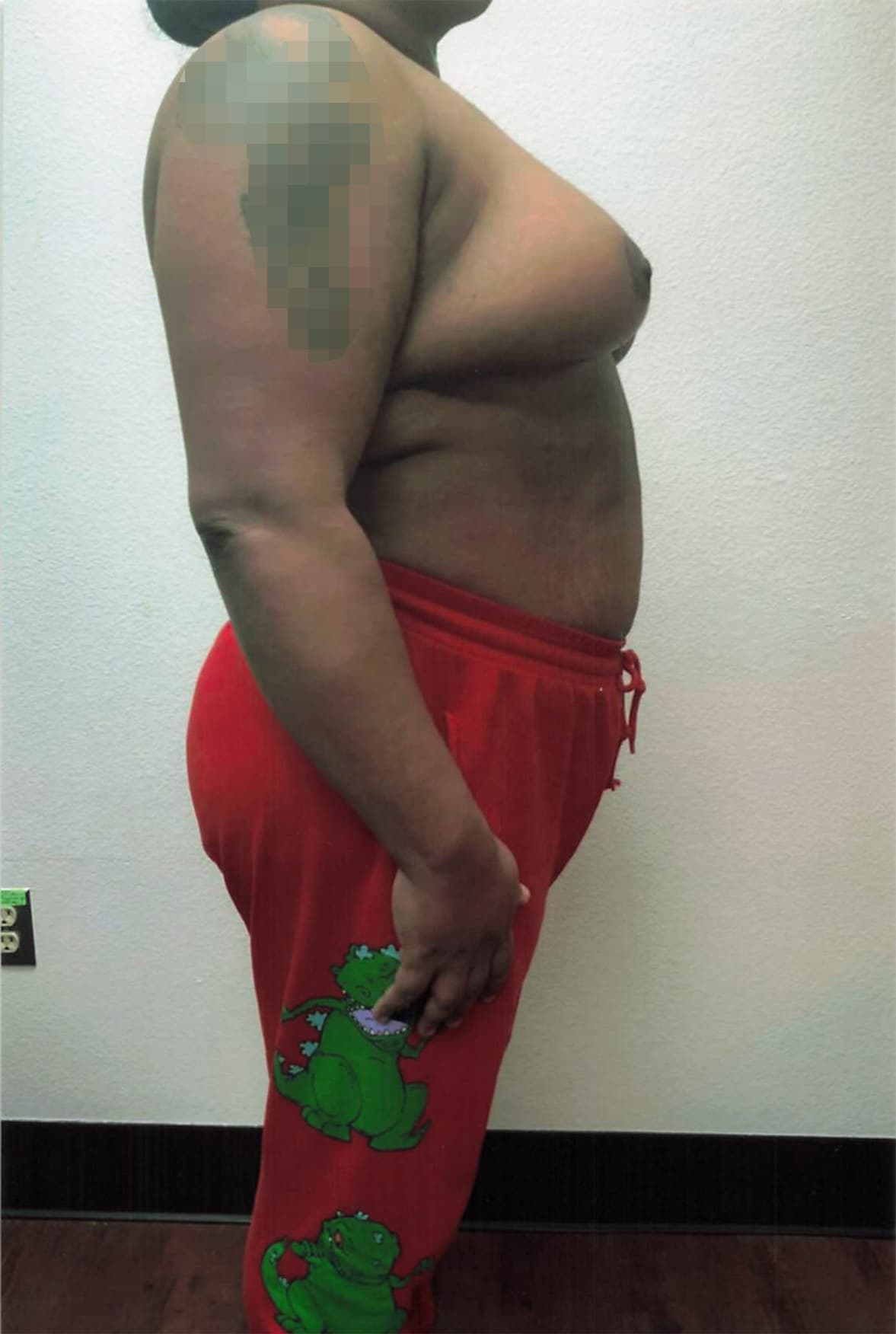 After Image: Breast Reduction - right-side