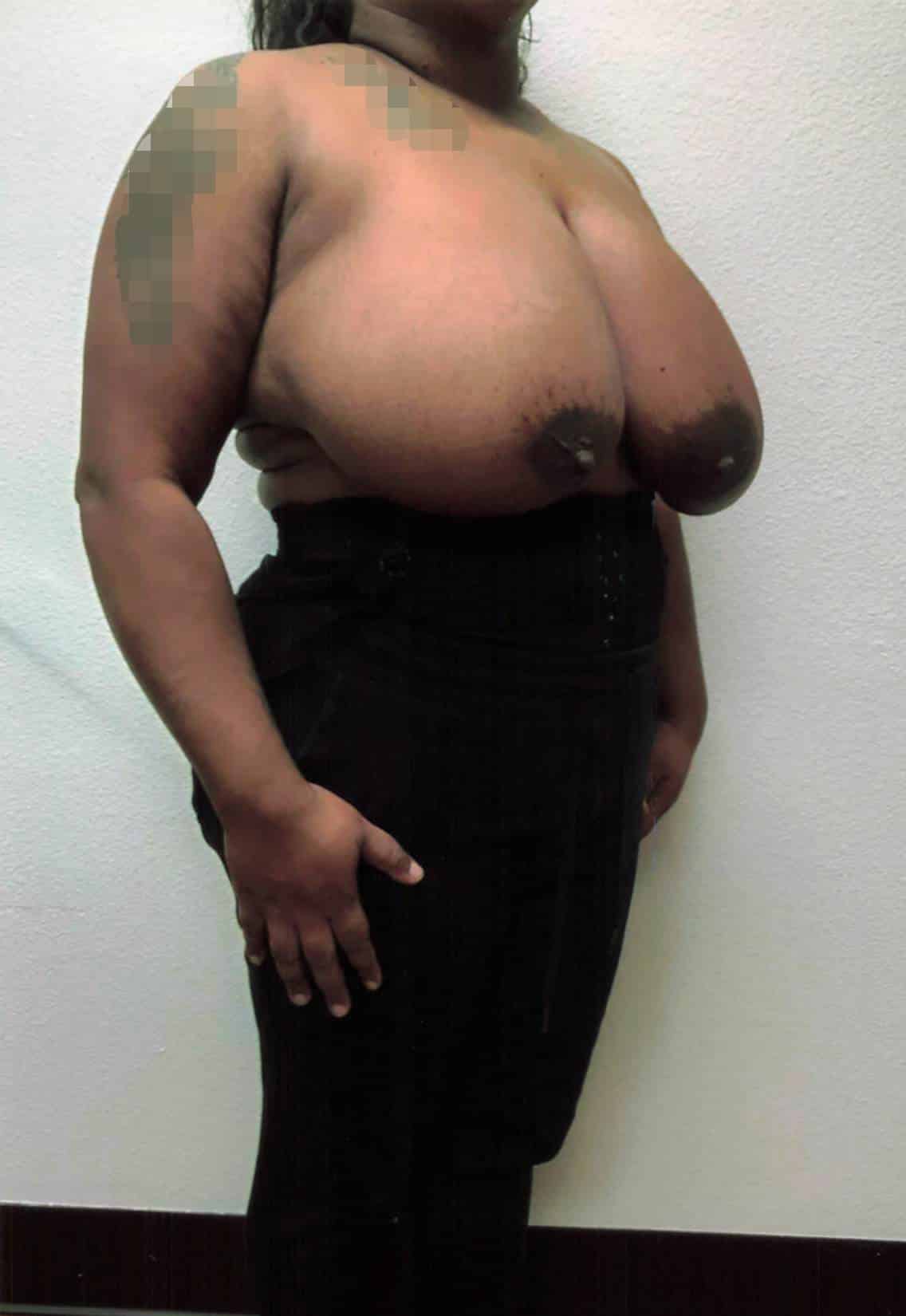 Before Image: Breast Reduction - right-front-oblique