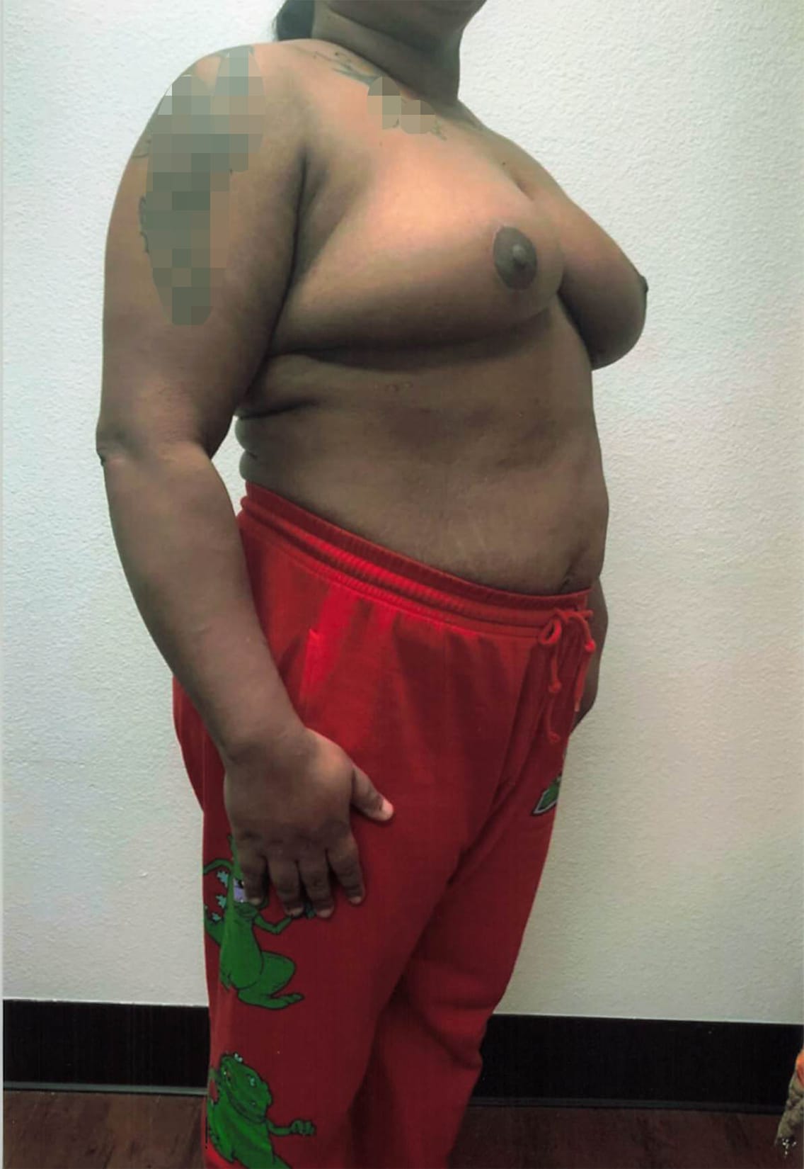After Image: Breast Reduction - right-front-oblique