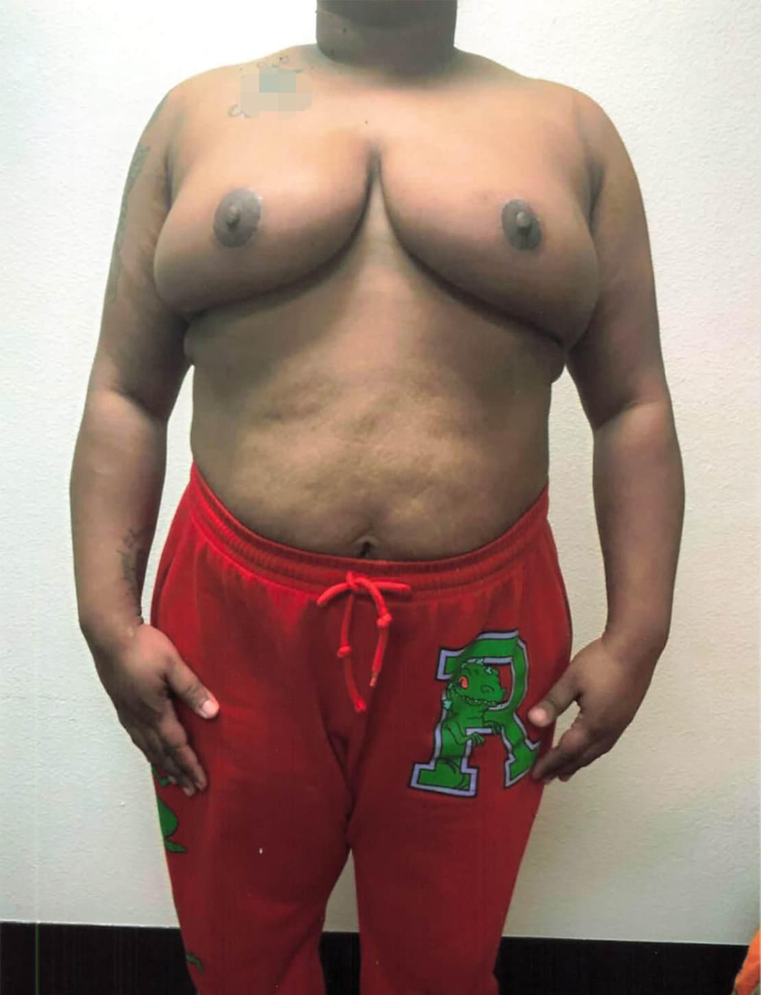 After Image: Breast Reduction - front