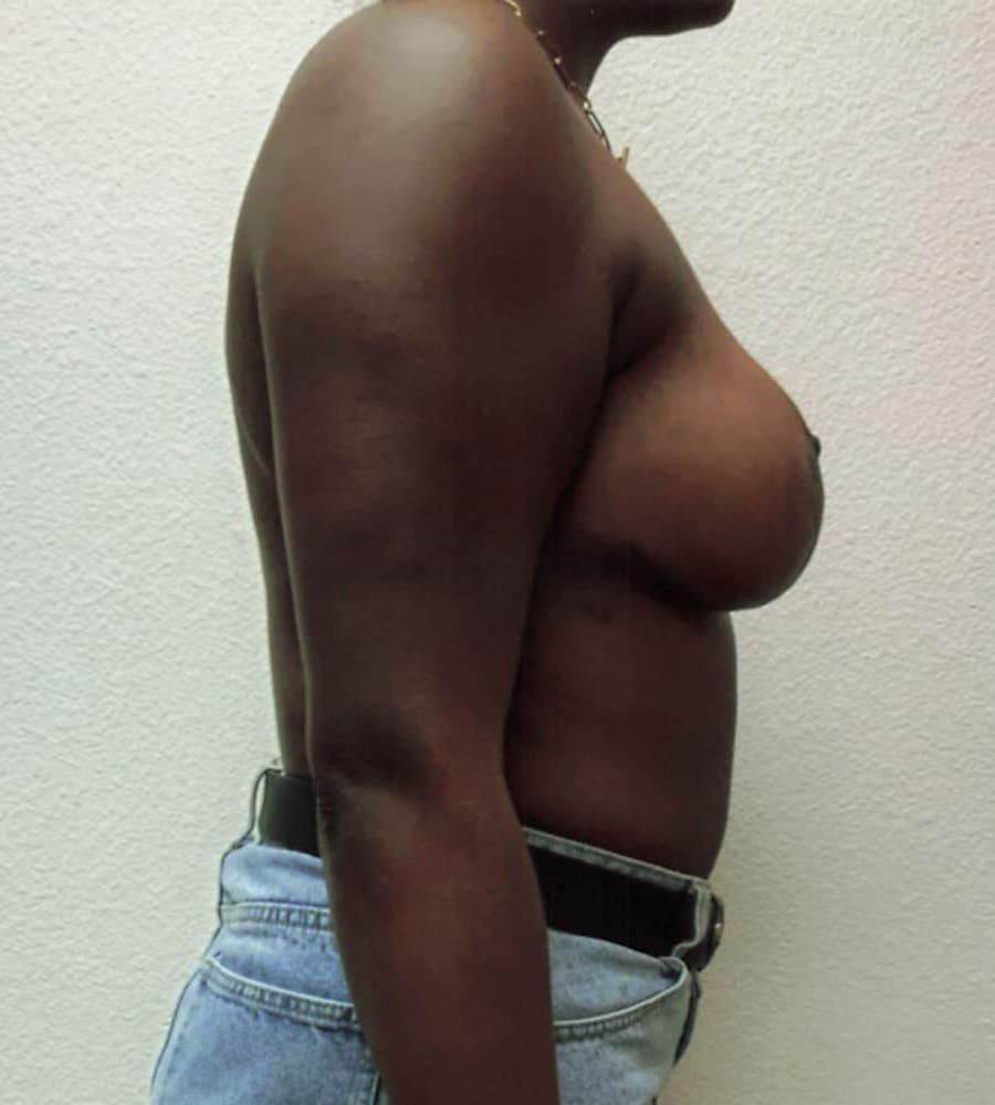 After Image: Breast Lift - right-side