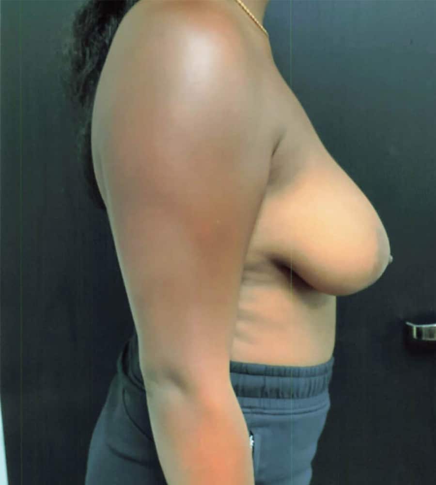 Before Image: Breast Lift - right-side