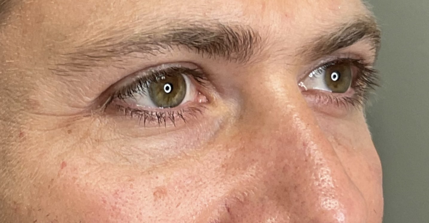 Before Image: Under Eye Filler - right-front-oblique