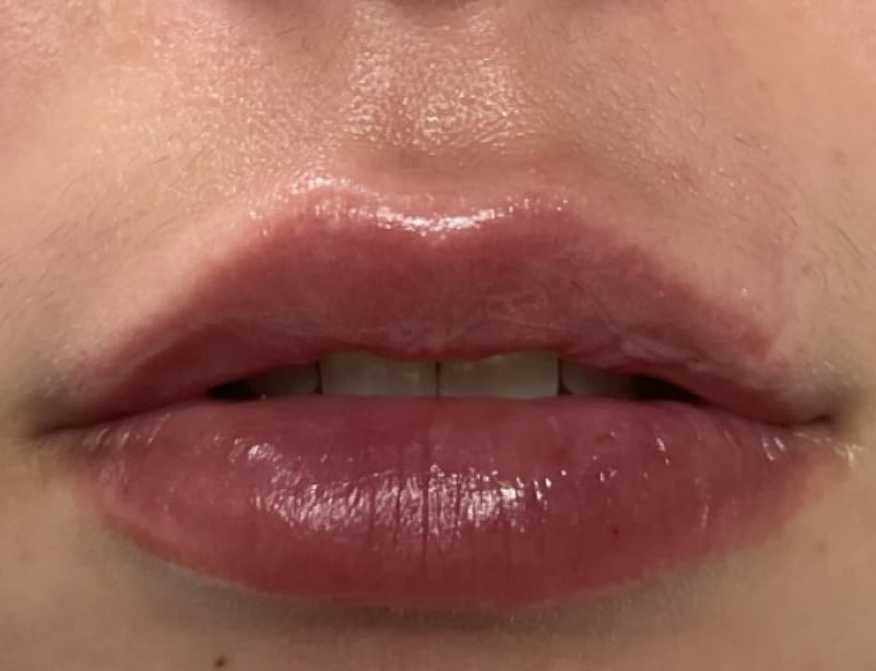 After Image: Lip Filler - front