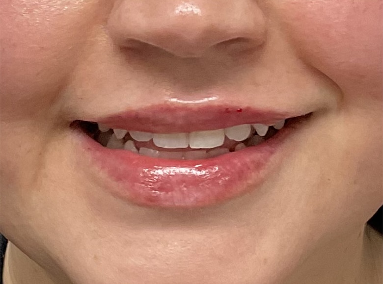 After Image: Lip Filler - front