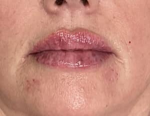 Lip Filler