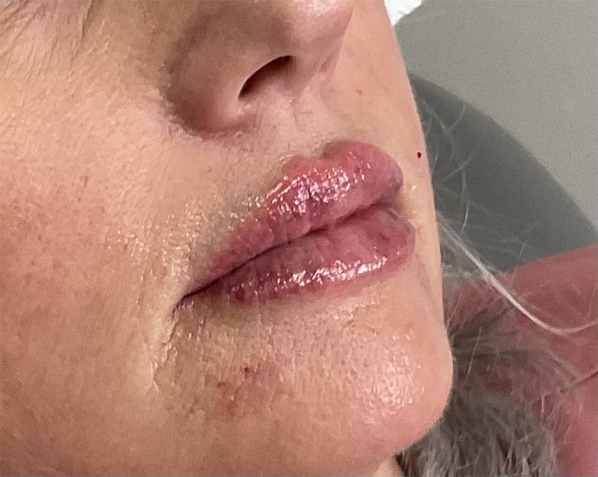 After Image: Lip Filler - right-front-oblique