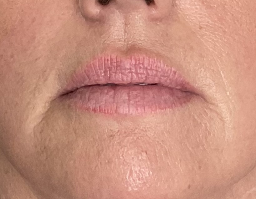 Before Image: Lip Filler - front