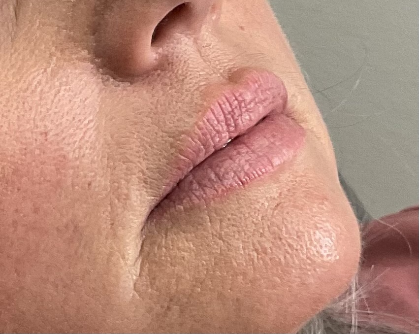 Before Image: Lip Filler - right-front-oblique
