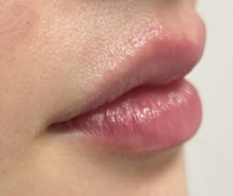 After Image: Lip Filler - right-front-oblique